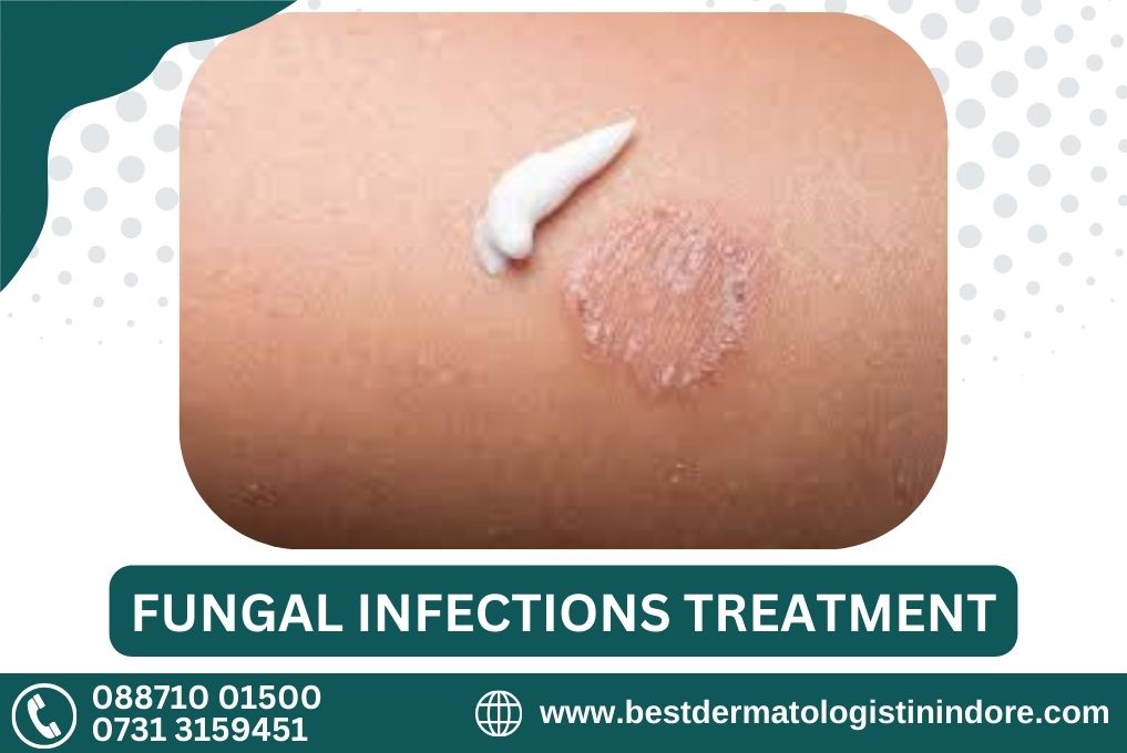 Best Skin Doctor For Fungal Infections Treatment In Pithampur